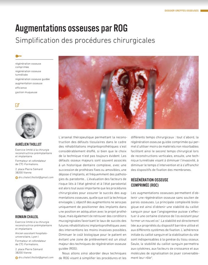 Augmentation osseuse par ROG (Titane 2023 - Volume 20) Augmentation osseuse par ROG (Titane 2023 - Volume 20)